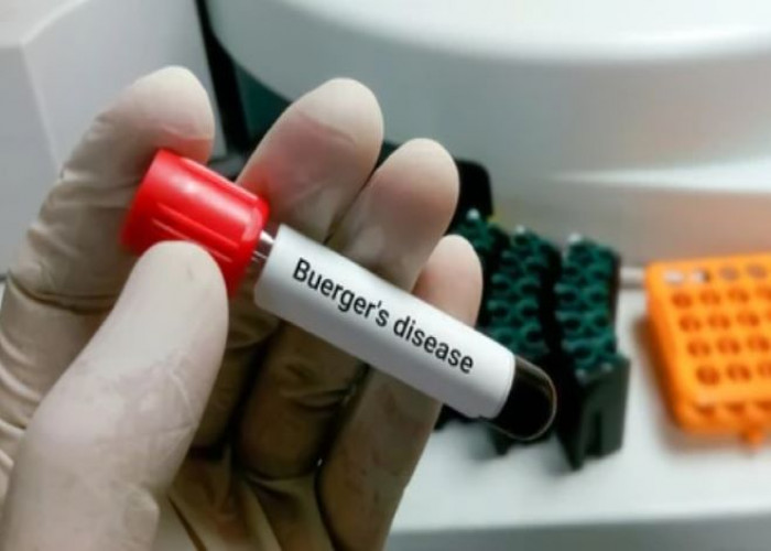 Buerger's disease