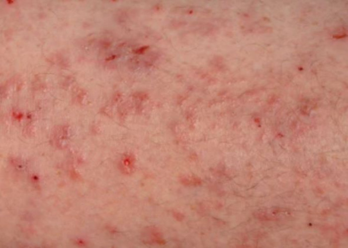 Scabies