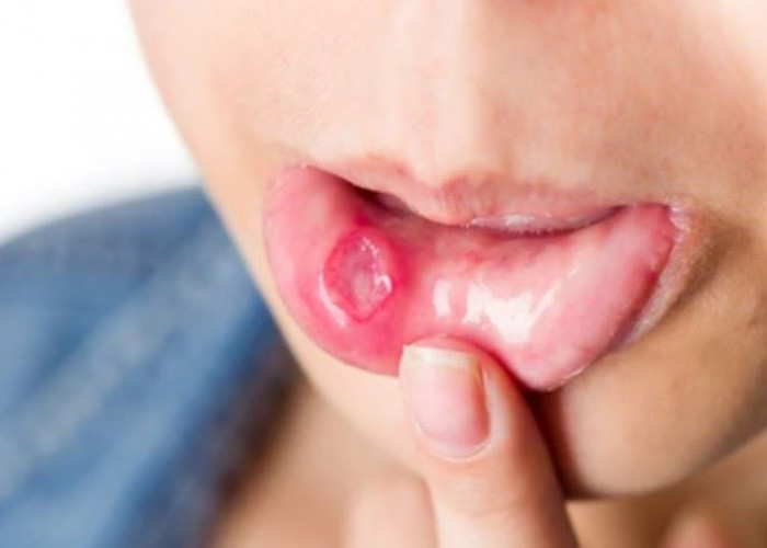 Canker sore