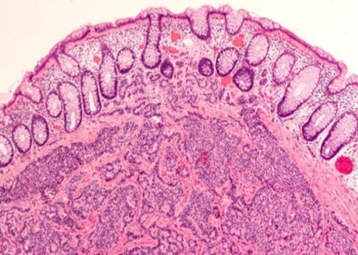 Carcinoid syndrome