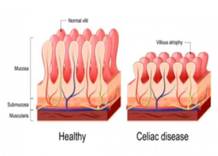 Celiac disease