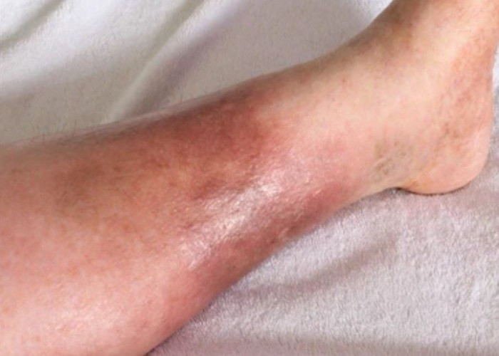 Cellulitis