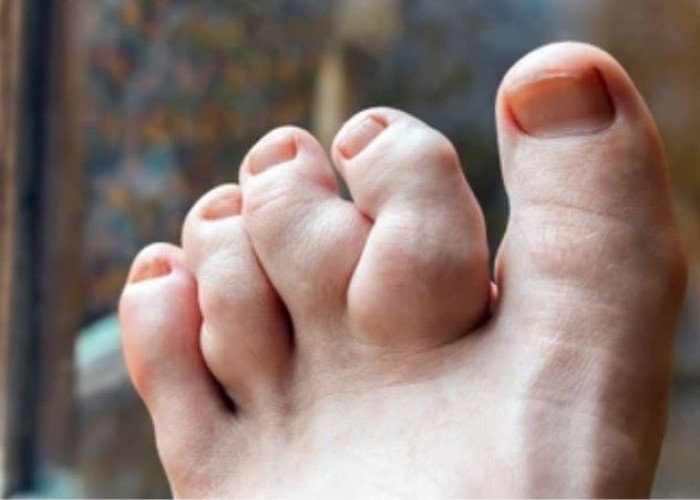 Chondrosarcoma