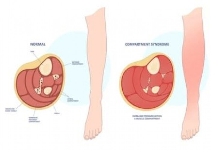 Chronic exertional compartment syndrome