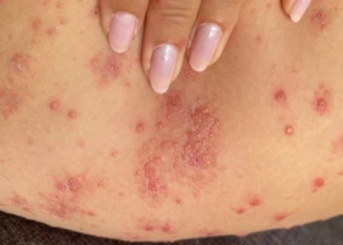 Chronic hives