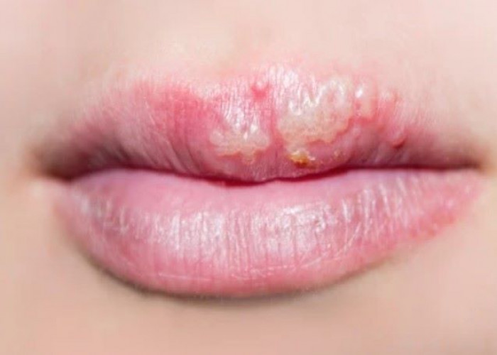 Cold sore