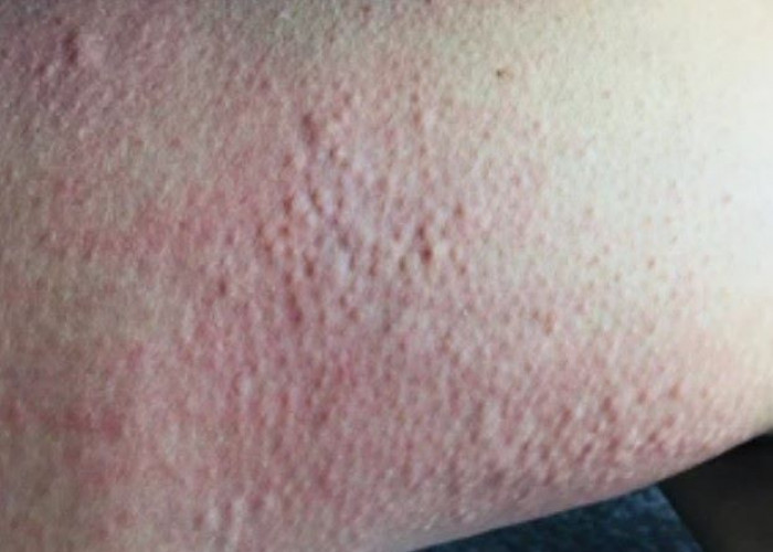 Cold urticaria
