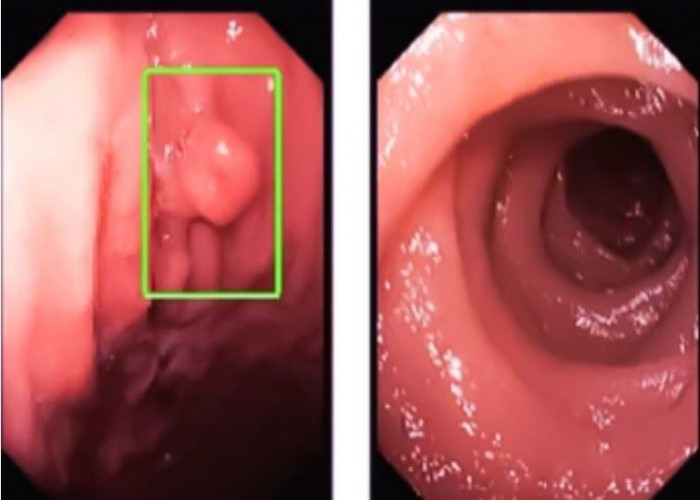 Colon polyps