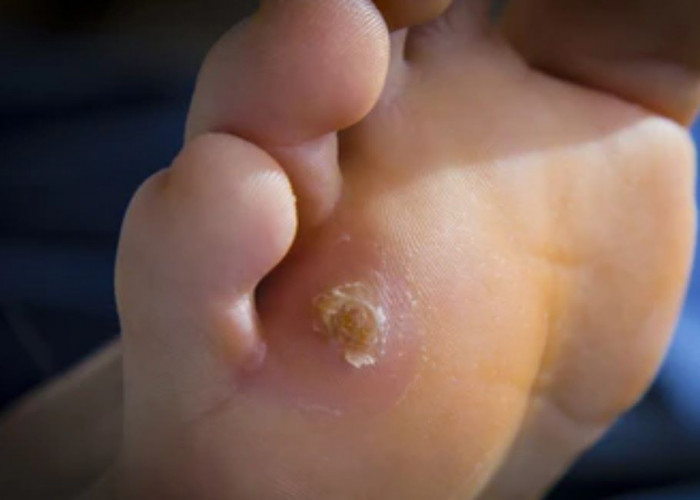 Corns and calluses