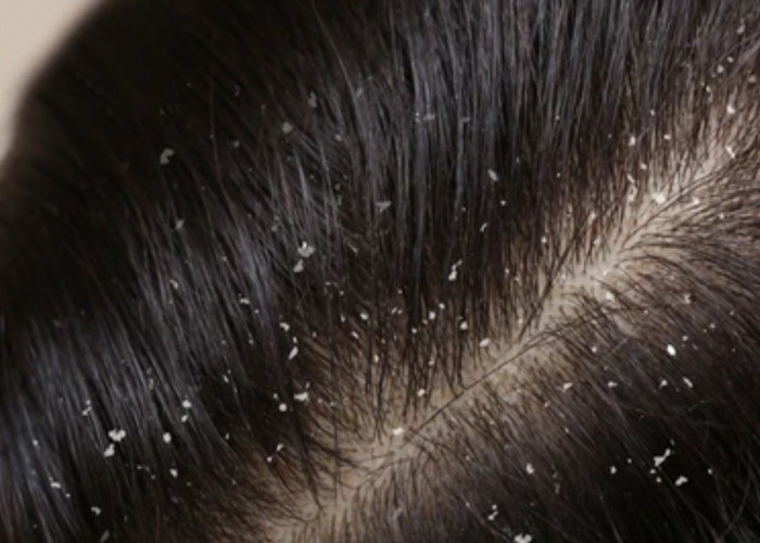 Dandruff