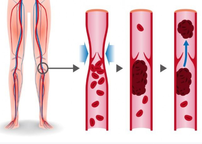 Deep vein thrombosis (DVT)