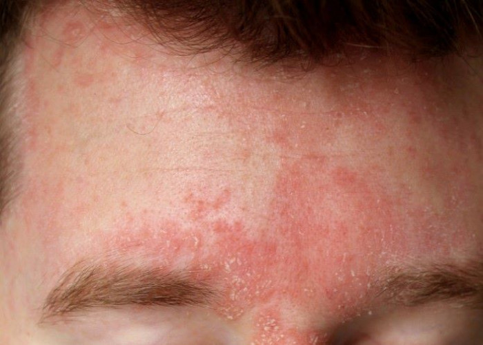 Dermatitis