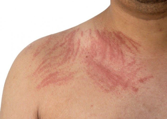 Dermatographia