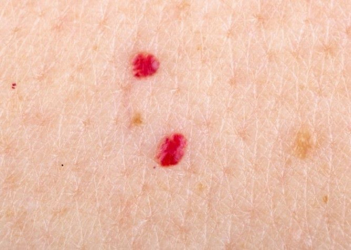 Desmoplastic small round cell tumors