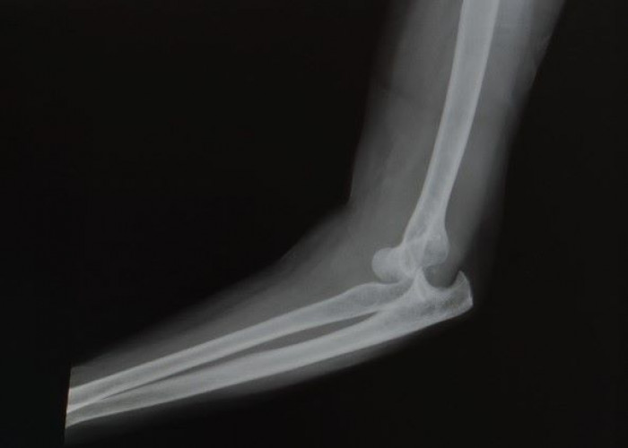 Dislocated elbow