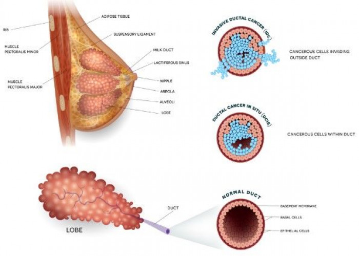 Ductal carcinoma in situ (DCIS)