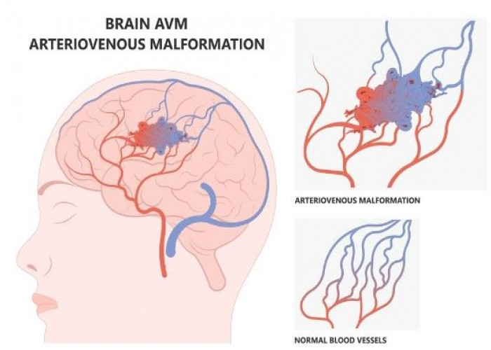 Dural arteriovenous fistulas