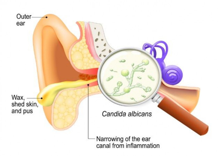 Ear infection (middle ear)