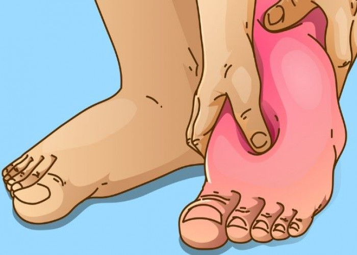 Edema