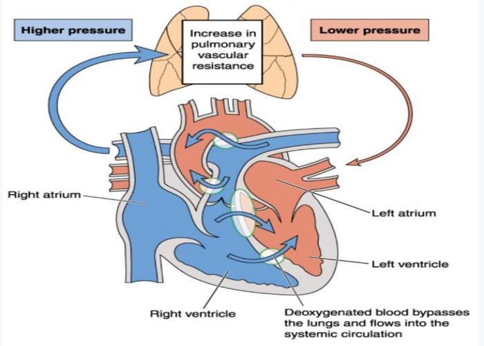 Eisenmenger syndrome