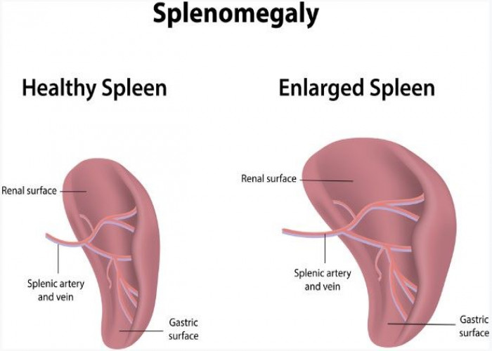Enlarged spleen (splenomegaly)