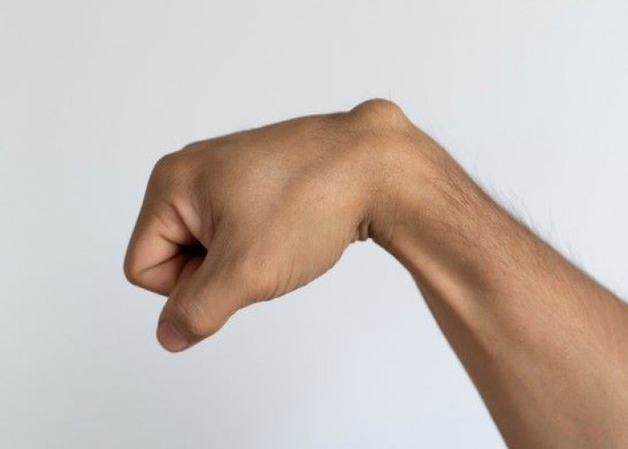 Epidermoid cysts