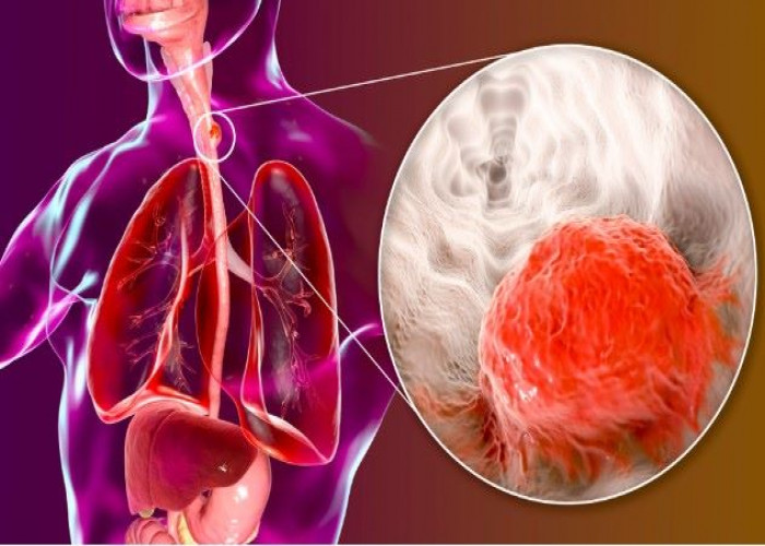 Esophageal cancer