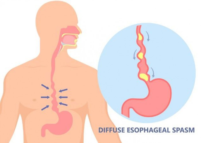 Esophageal spasms