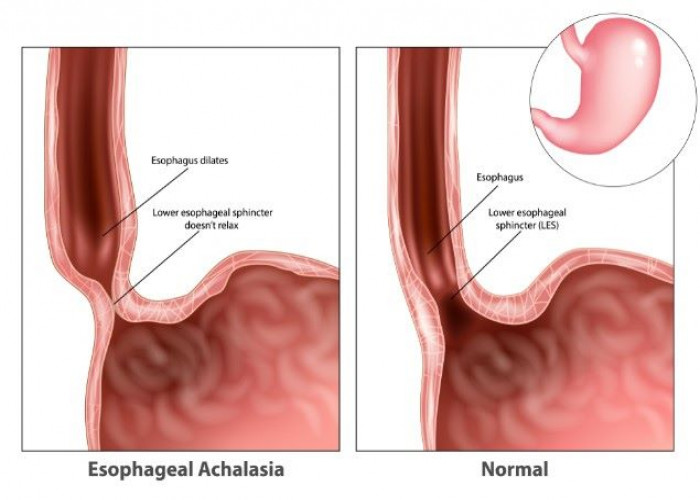 Esophagitis