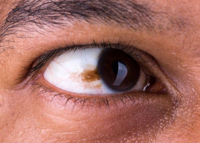 Eye melanoma