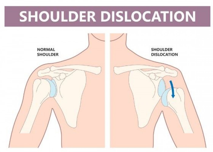 Dislocated shoulder