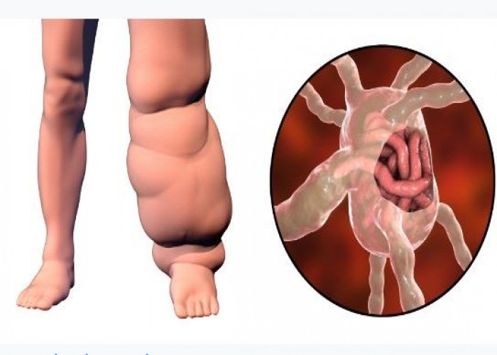 Filaria