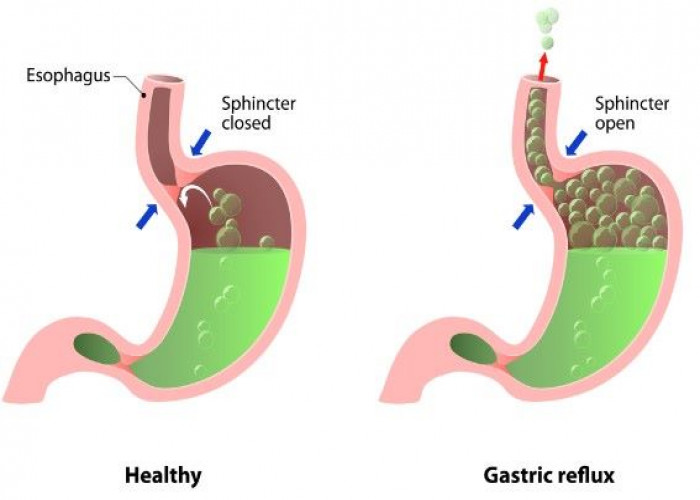 Gastroesophageal reflux disease (GERD)