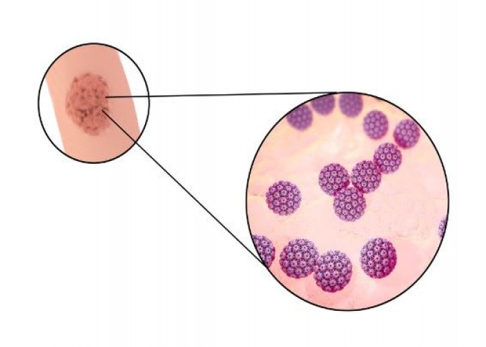 Genital warts