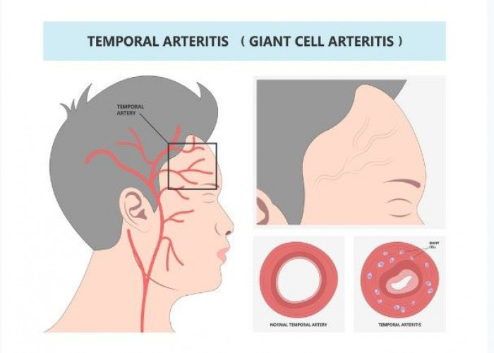 Giant cell arteritis