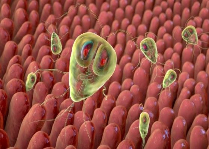 Giardia infection (giardiasis)