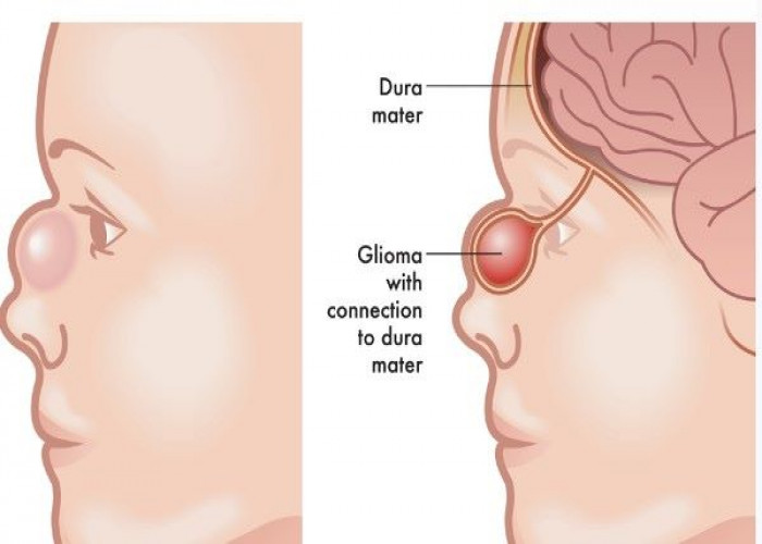 Glioma