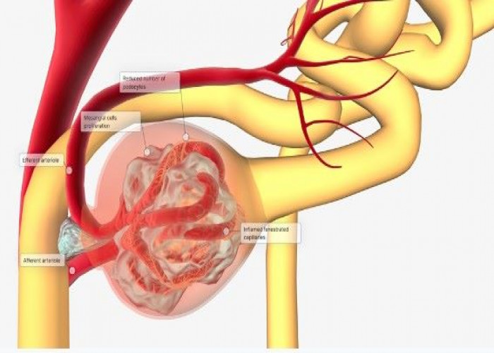 Glomerulonephritis