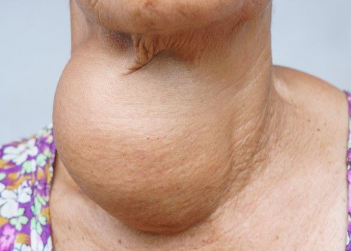 Goiter
