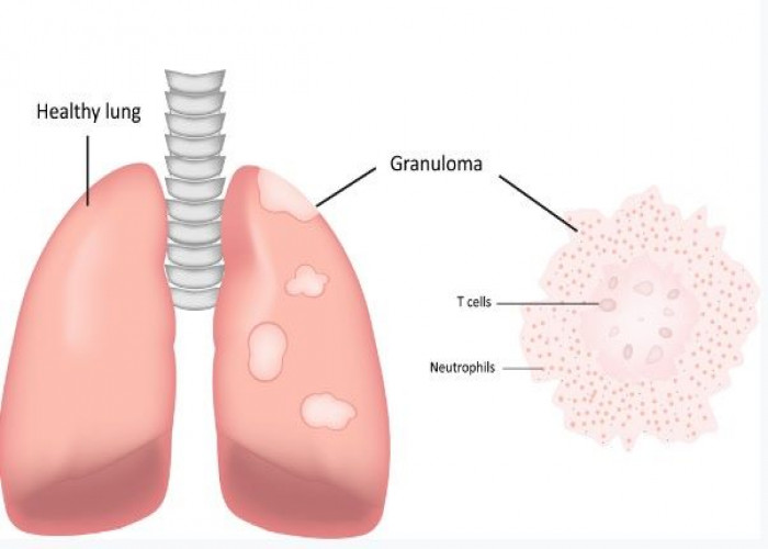 Granulomatosis with polyangiitis