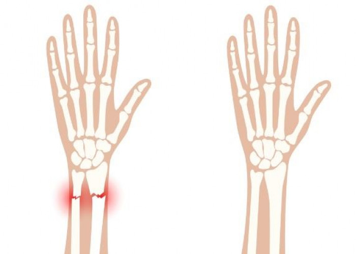 Greenstick fractures