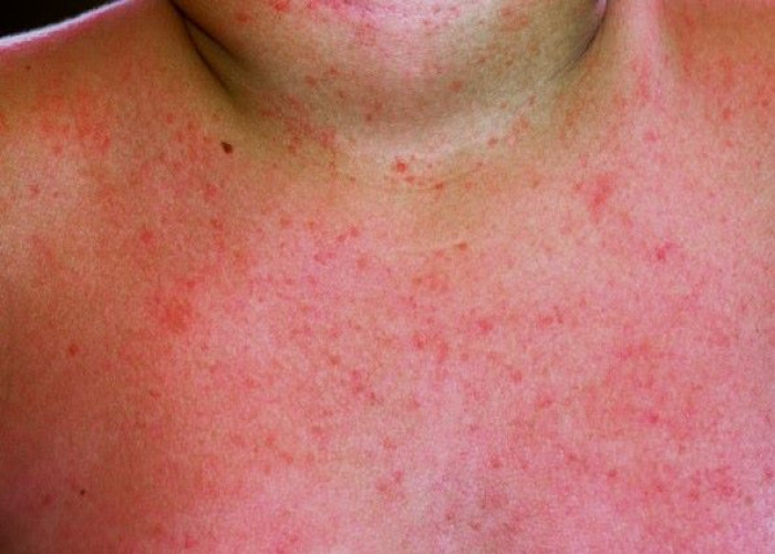 Heat rash