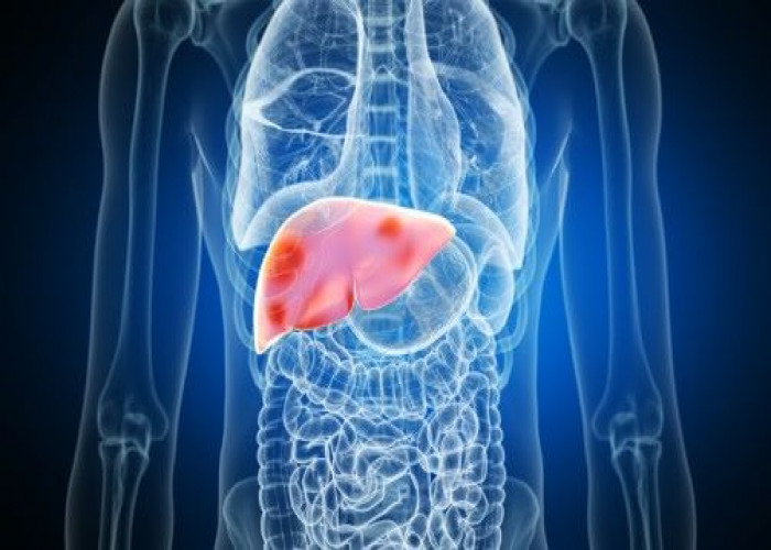 Hemochromatosis