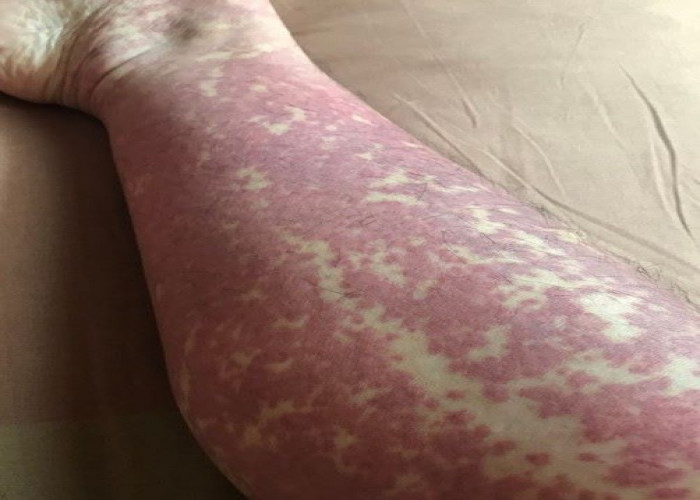 Henoch-Schonlein purpura
