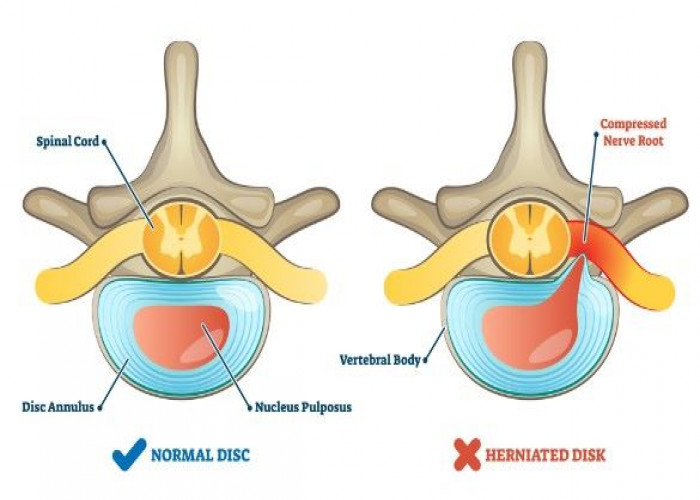 Herniated disk