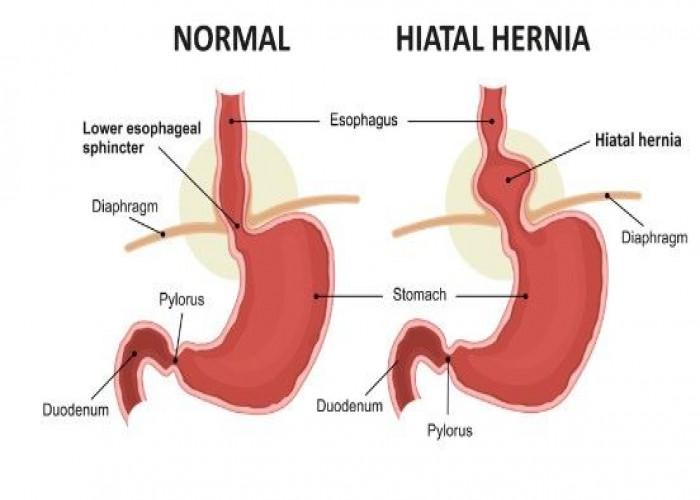 Hiatal hernia