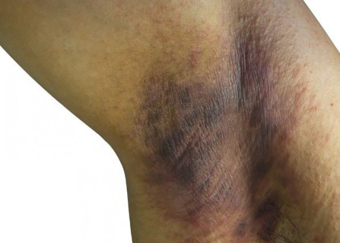 Hidradenitis suppurativa