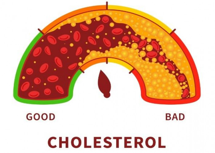 High cholesterol