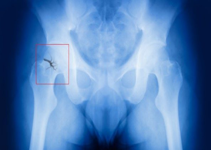 Hip fracture