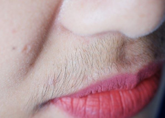 Hirsutism